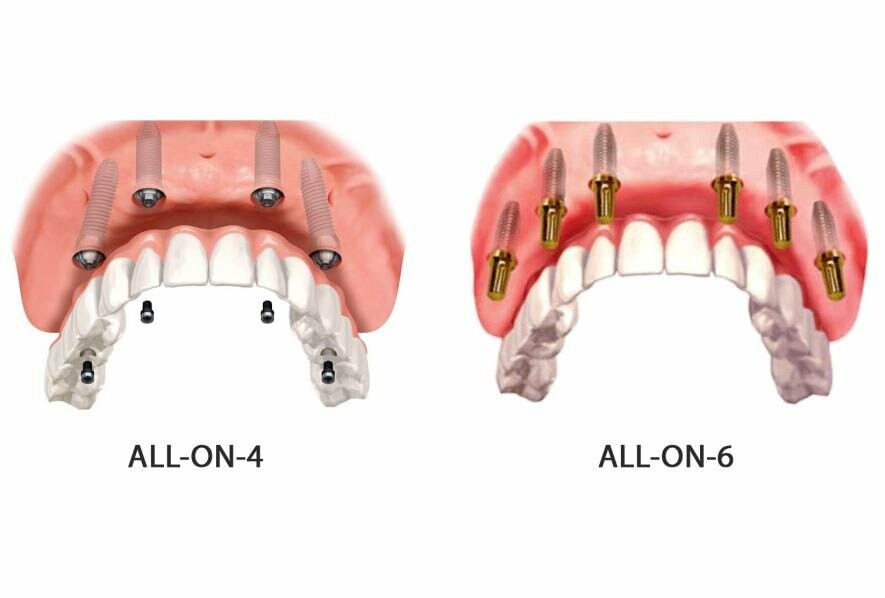 імплантація зубів all on 4 all on 6
