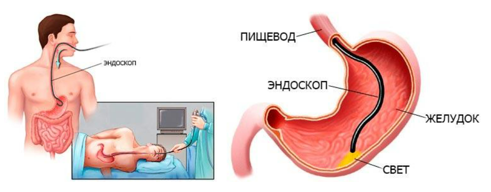 Гастроскопия сколько длится по времени. Двенадцатиперстная кишка ФГДС. Гастроскопическое исследование желудка.